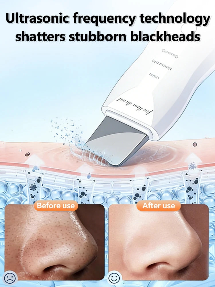 Limpiador Facial Ultrasónico con Iones y Microcorriente EMS – Limpieza Profunda de Poros